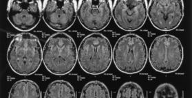 Unhealthy food may be shrinking your brain
