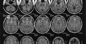 Probiotic for Alzheimers Disease: first clinical study
