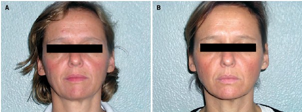 skin before and after stopping smoking 